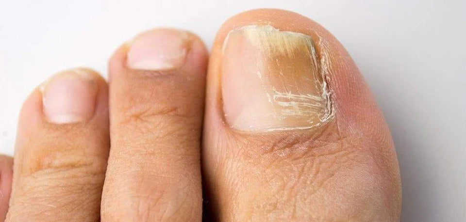 How to Get Rid of Toenail Fungus