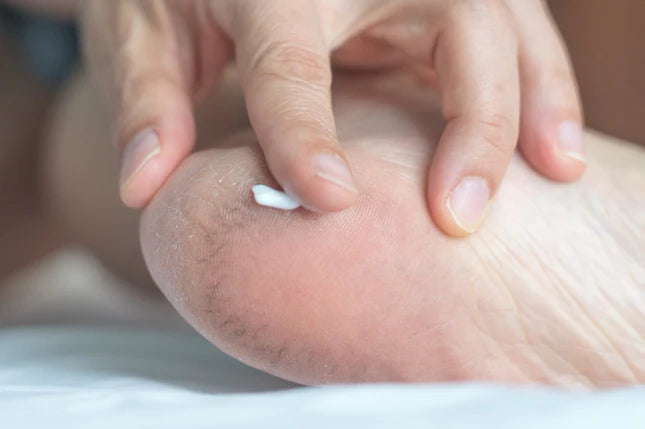 What Causes Cracked Heels &amp; How Can I Prevent Them?