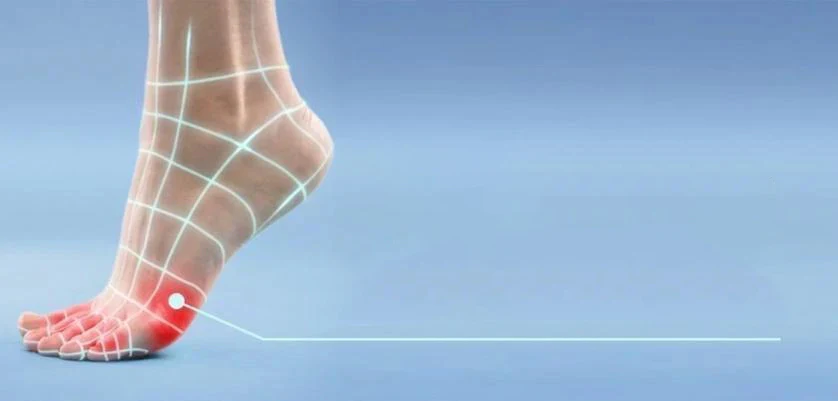 Corns and calluses