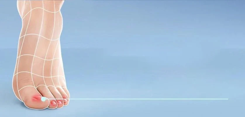 Ingrowing toenail