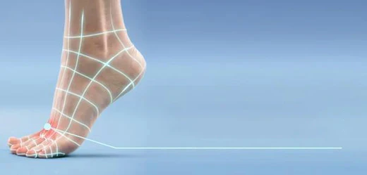 Bunions