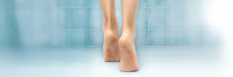 Cracked Heels