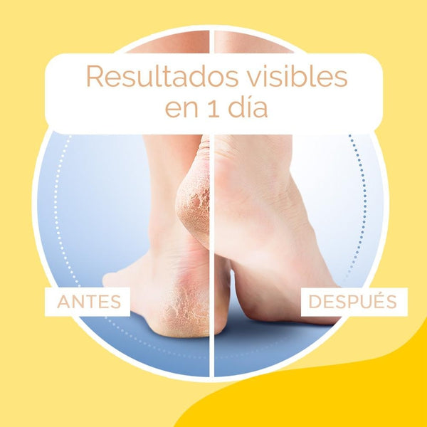 Creme Scholl para calcanhares gretados