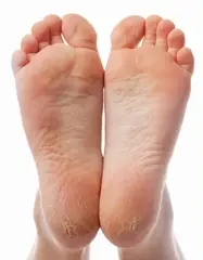 Condition_Cracked_Heel_mediumjpg - Dr. Scholl's™ UK